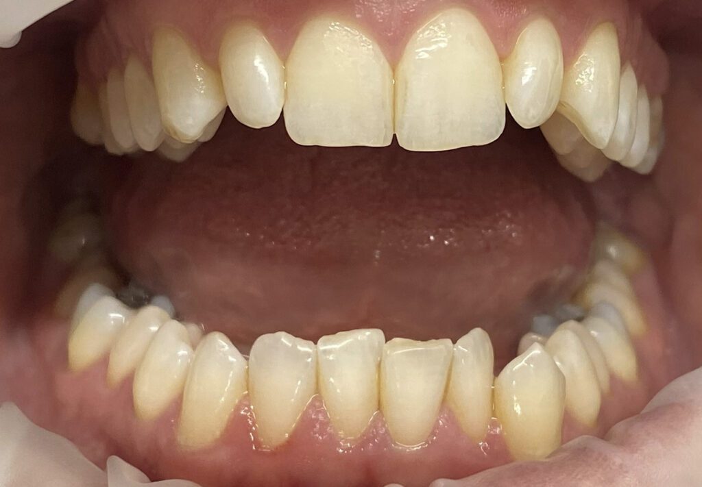 Composite Dental Bonding Bromley Before
