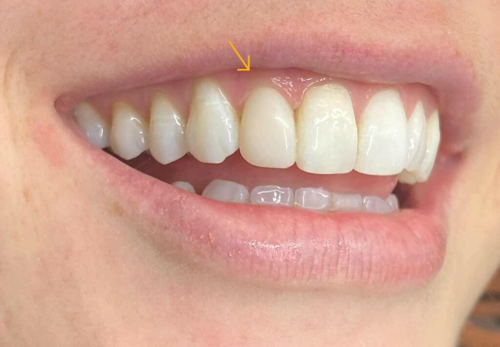 Cosmetic Bonding Bromley Single Tooth After