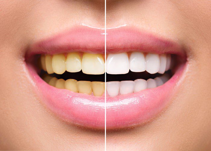Teeth whitening in Bromley - Before and After Treatment