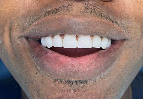 Composite Bonding Chipped Teeth After