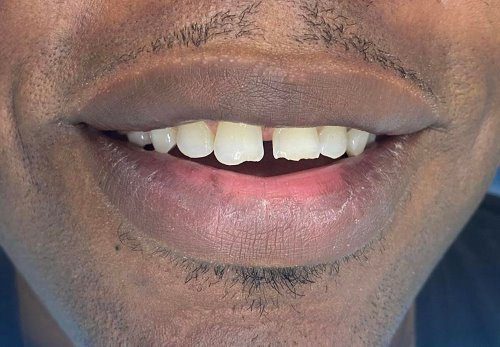 Composite Bonding Chipped Teeth Before