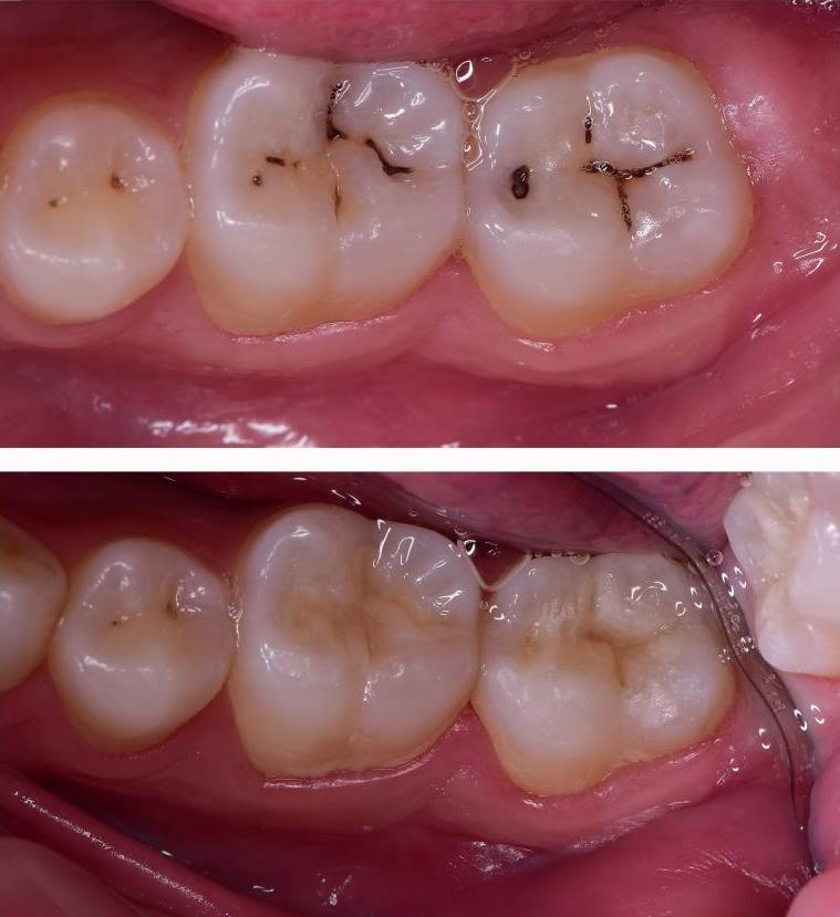 Amalgam Filling Replaced with White Filling Bromley London