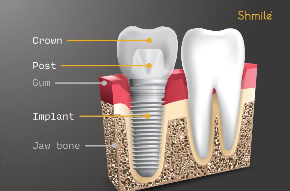 Dental ImplantsBbromley
