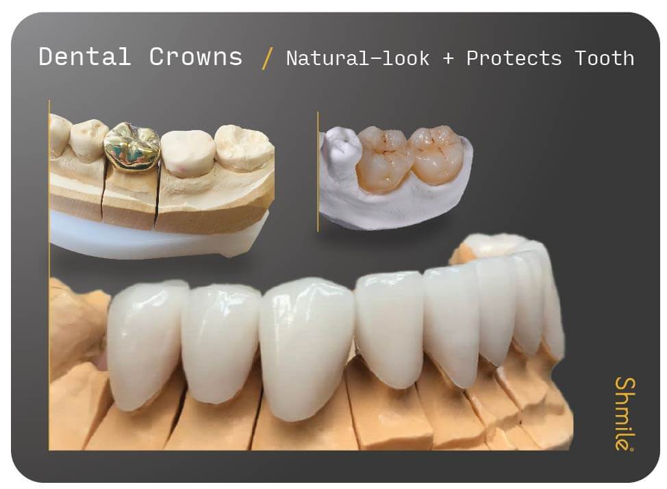 Dental Crowns & Bridges Bromley Kent