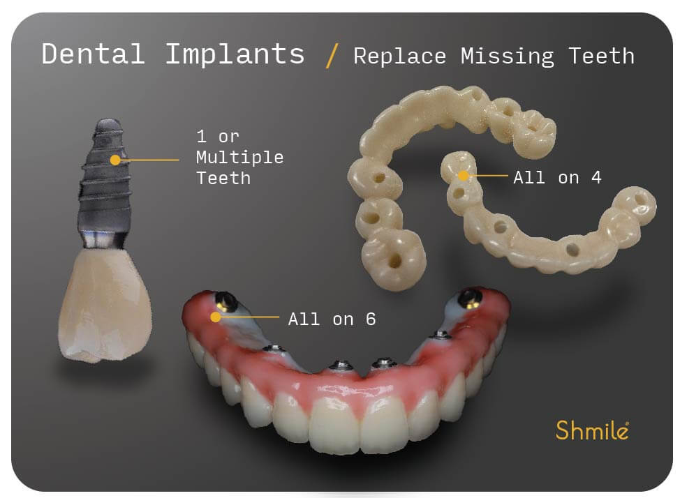 Dental Implants in Bromley London