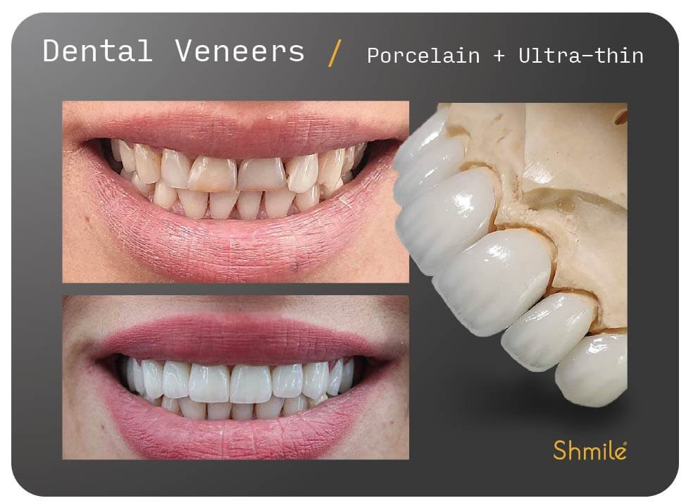 Dental Veneers Bromley London - Porcelain