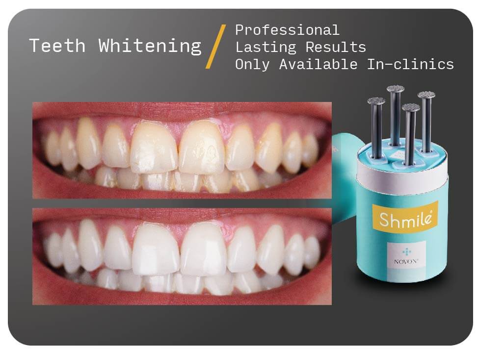 Teeth Whitening Bromley London - Cosmetic Dentist