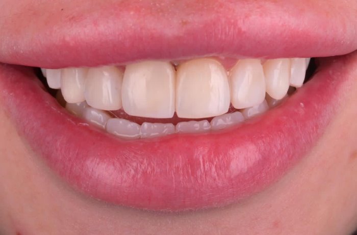 Dental Venees in Bromley After Treatment