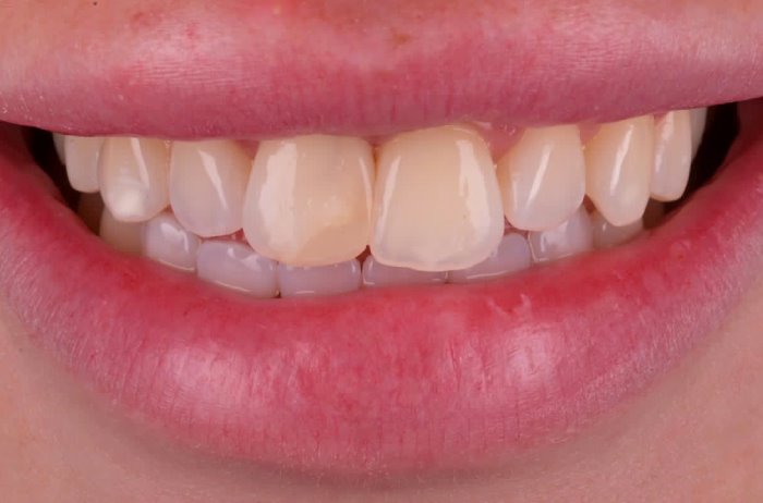 Dental Venees in Bromley Before Treatment