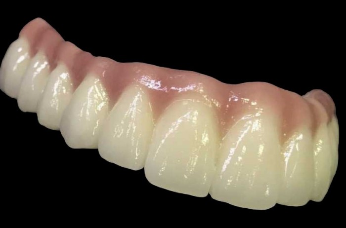 Allon4 Dental Implants Bromley