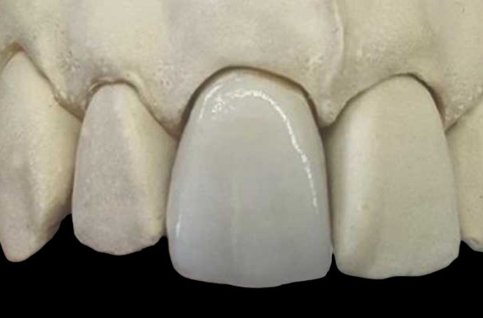 Single Tooth Implant Crown