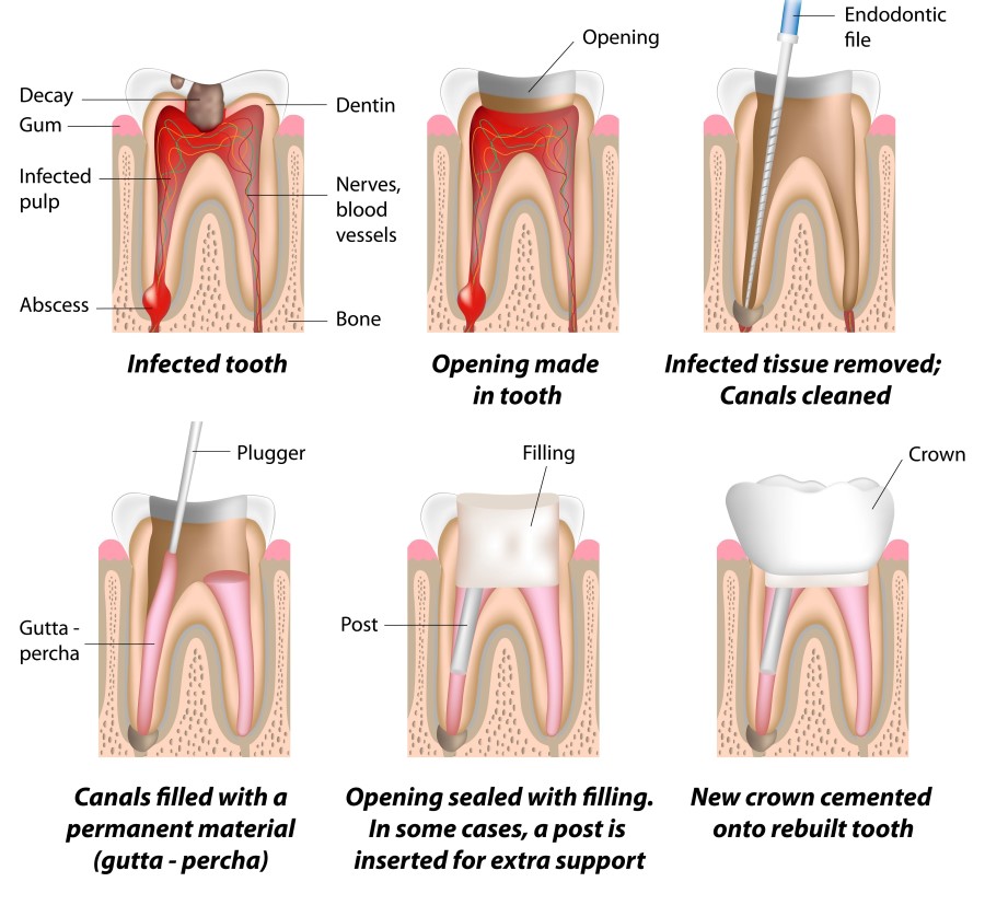 Root Canal Treatment Procedure Bromley