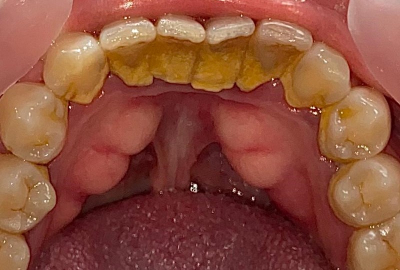 Teeth Plaque Removal Before
