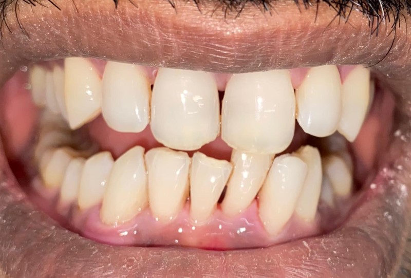 Ultrasonic Teeth Cleaning After