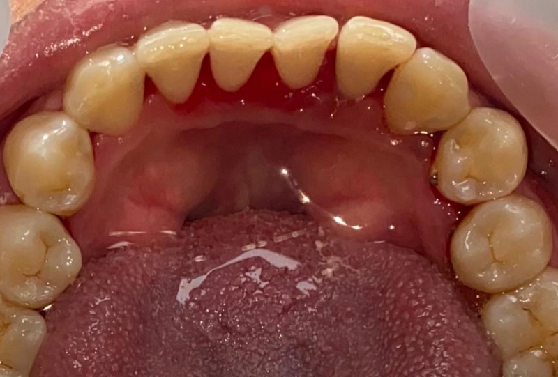Teeth Plaque Removal After